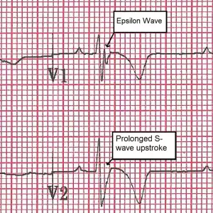 ARVC 2